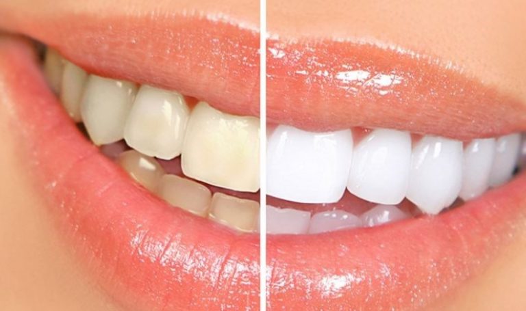Dişlerin görünümünde doğru bilinen hatalar – Sağlık Haberlerini Kırma