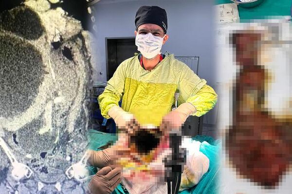 Dünya literatürüne giren vaka: Karnı ve karaciğeri kistle kaplıydı! 90 santimetreye ulaşan kedi-köpek kisti çıkarıldı! “Ölümüne sebep olabilir”