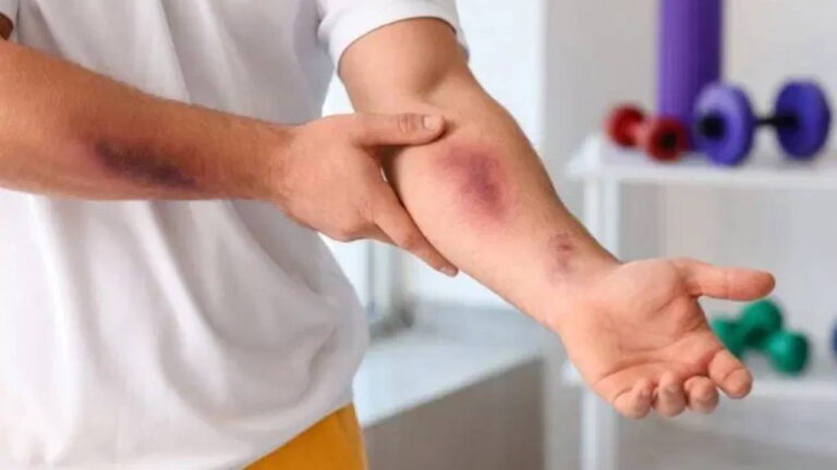 Uzmanı uyardı: Geçmeyen morarma ve kanamalara dikkat! – Son Dakika Yaşam Haberleri